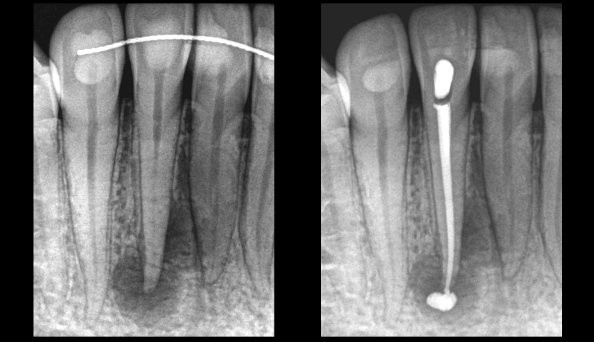 BLOG - Dr Brice Riera - Endodontie - Regeneration osseuse