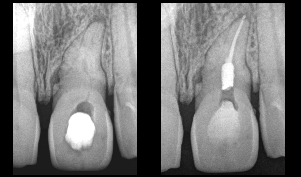 BLOG - Dr Brice Riera - Endodontie - cas dent n 21