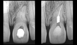 BLOG - Dr Brice Riera - Endodontie - cas dent n 21