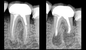 BLOG - Dr Brice Riera - Endodontiste - Pulpes precedemment traitees