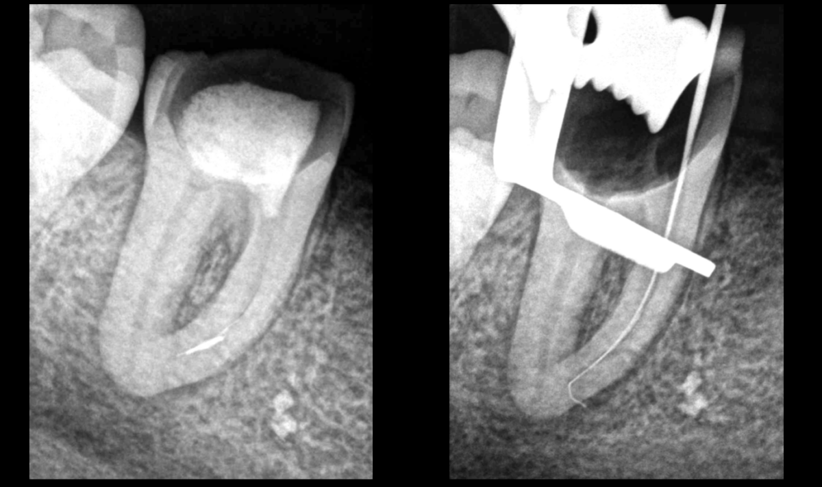 BLOG - Dr Brice Riera - Strategie pour instrument endodontique oublie dans canal