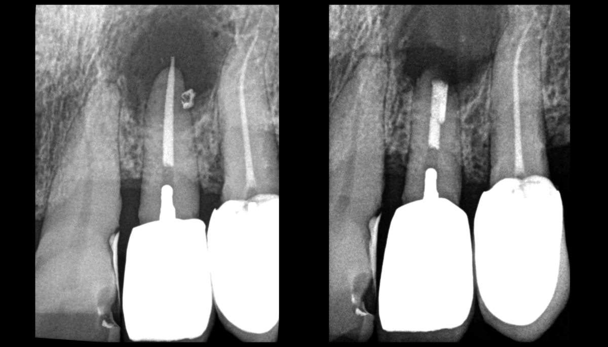 Blog - dr brice riera - endodontie a paris - cas de regeneration longue