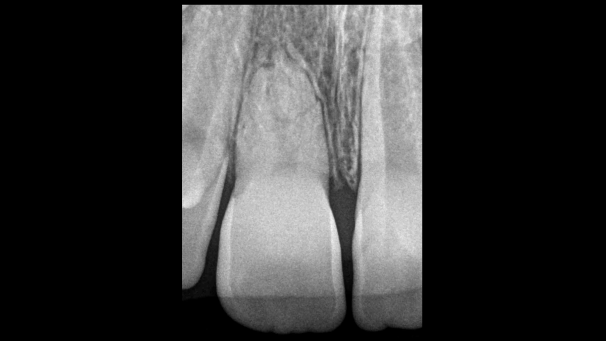 Blog - dr brice riera - endodontiste - quelle decision therapeutique endodontique