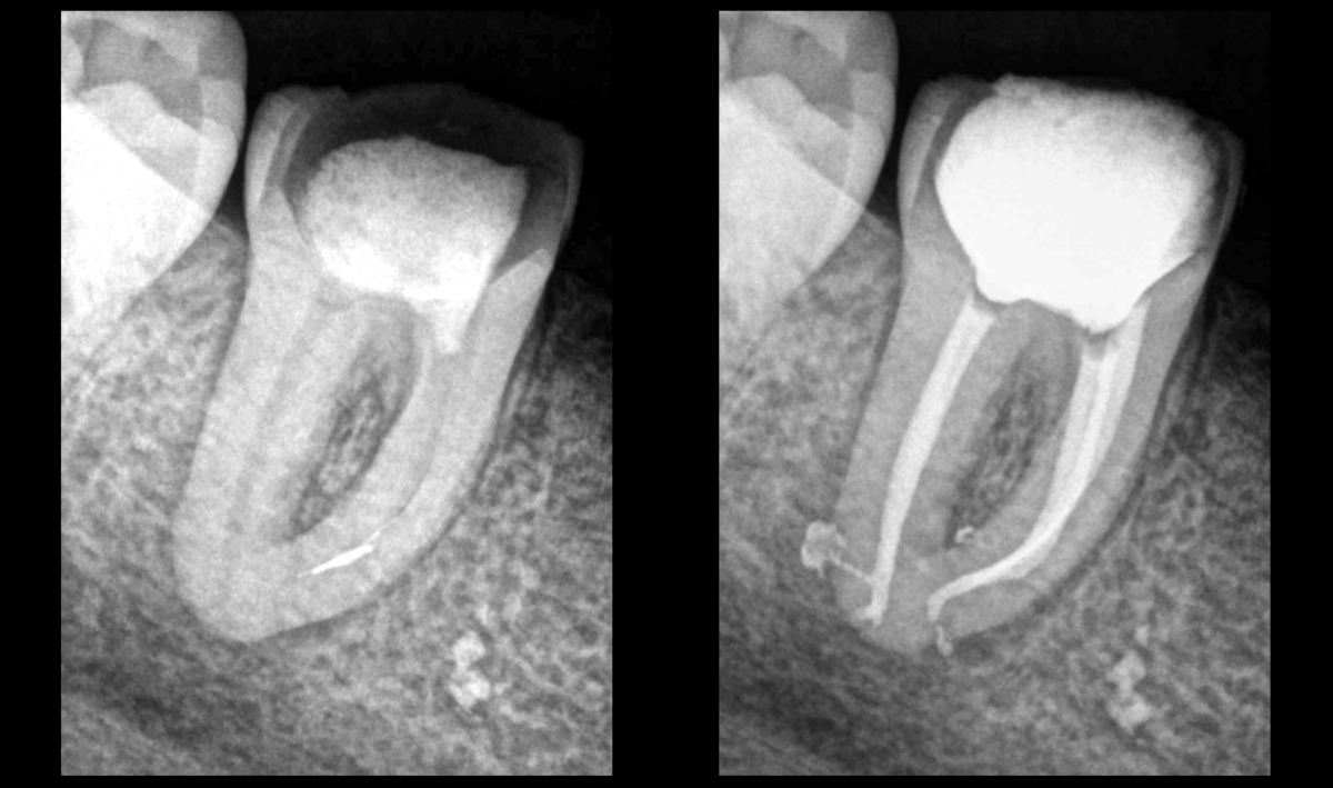 blog - dr brice riera - instrument fracture