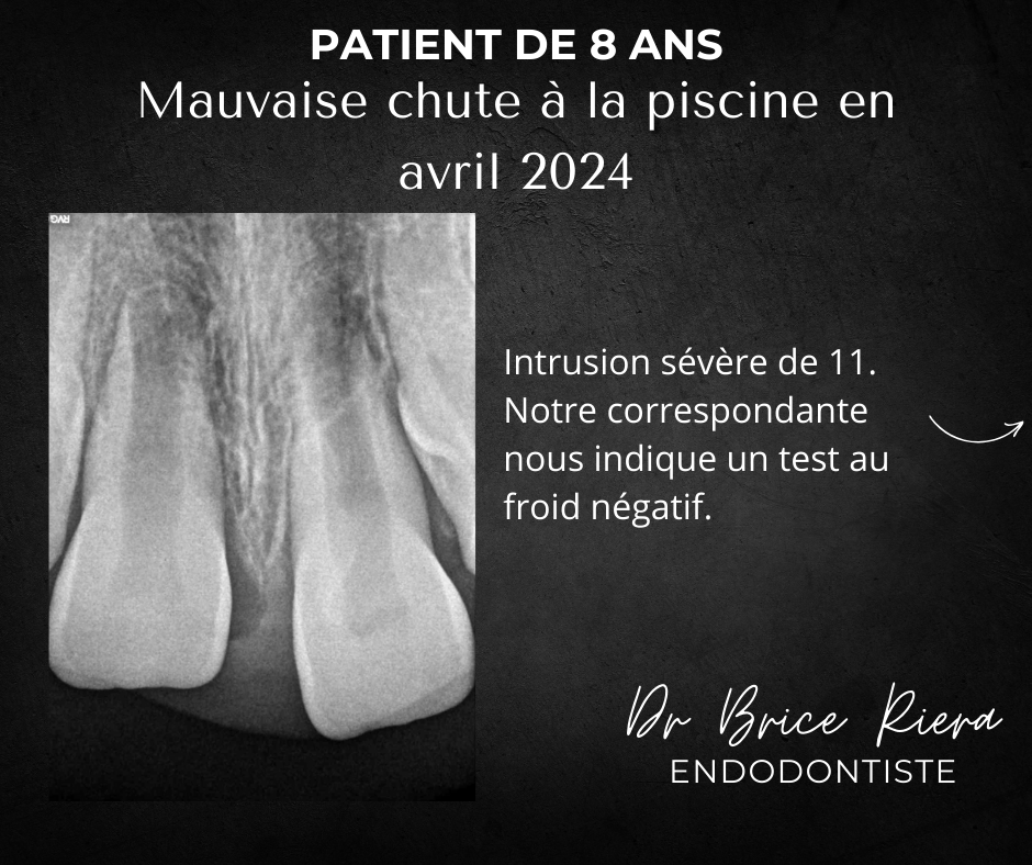 Blog - Dr Brice Riera - Endodontie - INtrusion severe