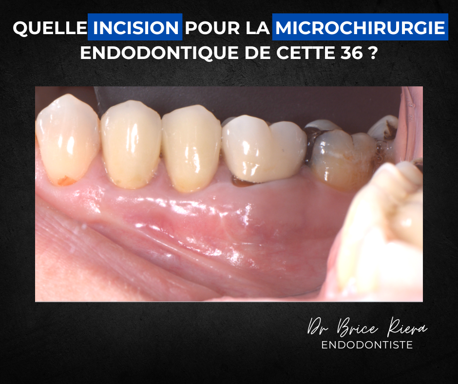 Dr Brice Riera Endodontie - Quelle incision