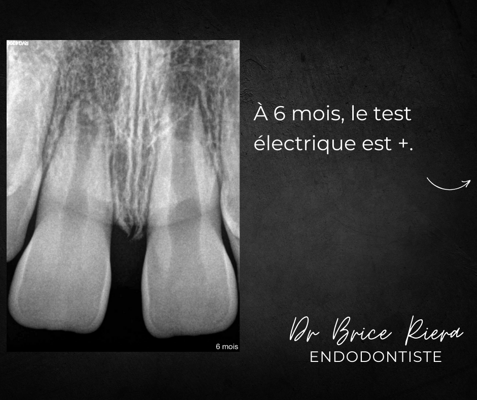 Blog - Dr Brice Riera - Endodontie - INtrusion severe