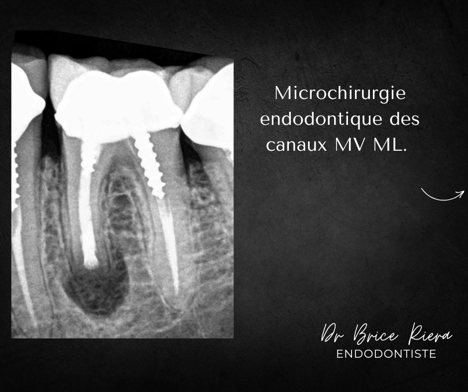 Blog - Dr Brice Riera - dent 36