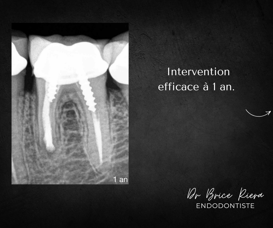 Blog - Dr Brice Riera - dent 36