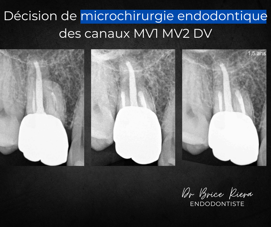 Dr Brice Riera Endodontiste - microchirurgie