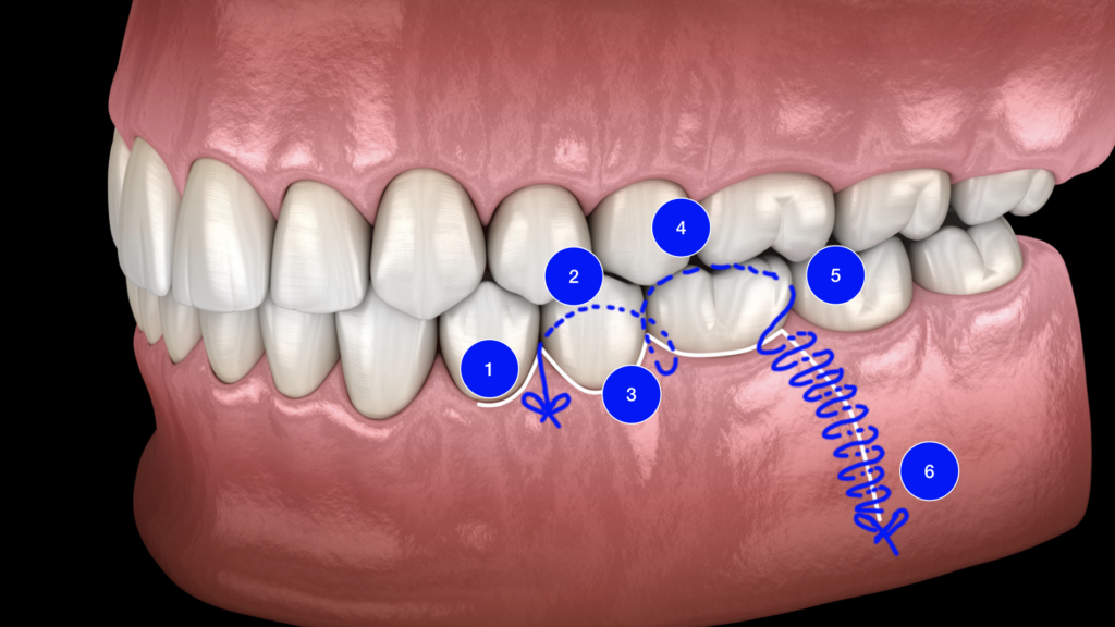 BLOG - Dr Brice Riera - Endodontie - incision