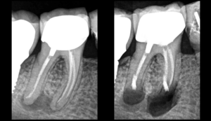 BLOG - Dr Brice Riera - Endodontie microchirurgie dentaire