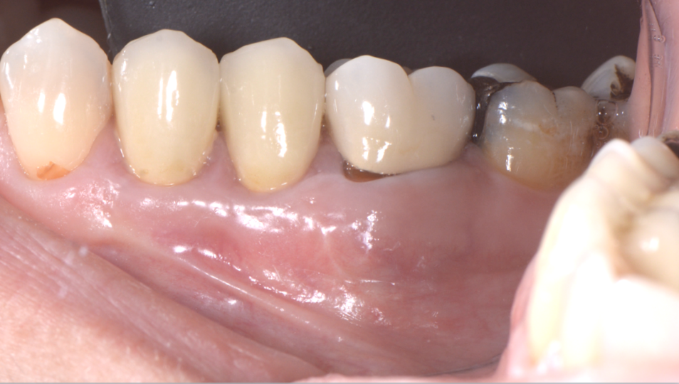 BLOG - Dr Brice Riera - Endodontiste - Incision