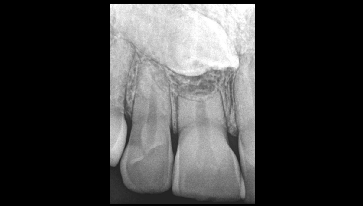 BLOG - Dr Brice Riera - Endodontiste Paris - traitement endodontique ou non