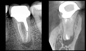 BLOG - Dr Brice Riera - Endodontiste - dent 37