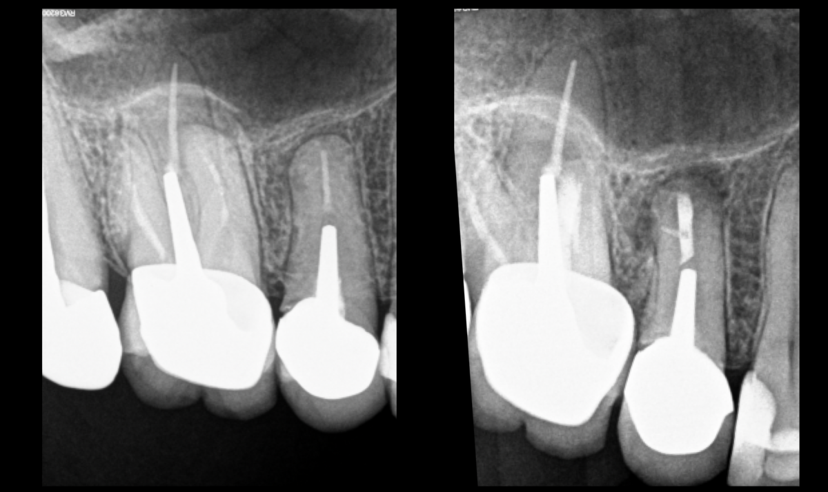 BLOG - Dr Brice Riera - Endodontiste - dents 15 et 16