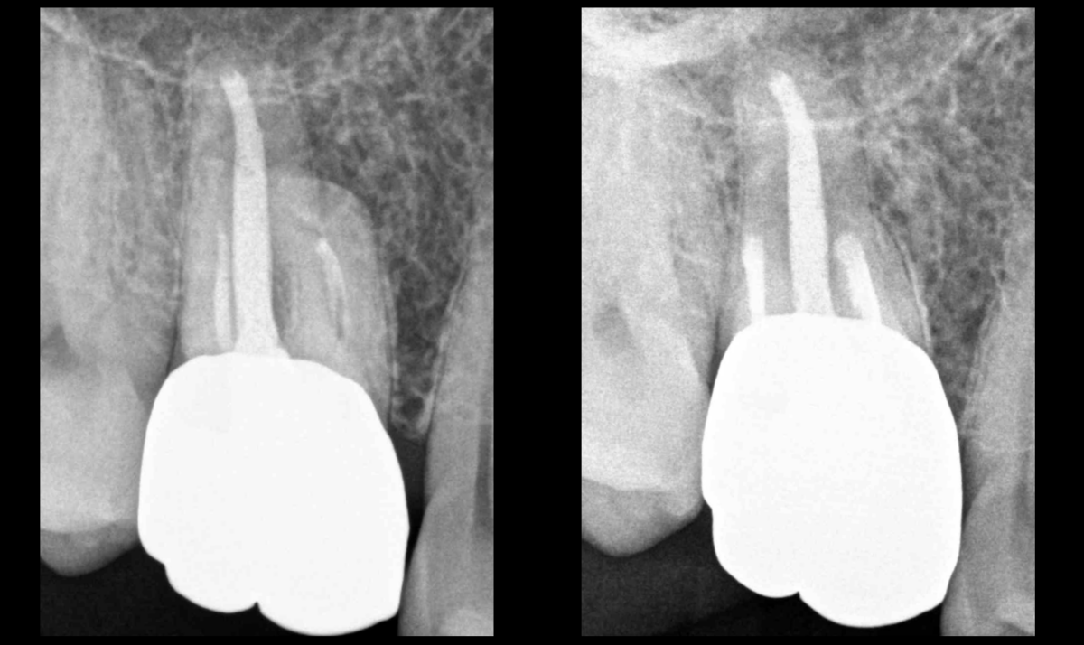 BLOG - Dr Brice Riera - pulpe precedemment traitee