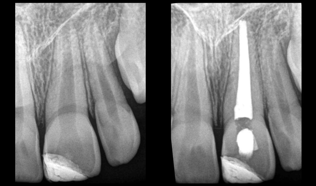 Blog - Dr Brice Riera - Cas traumatisme dentaire