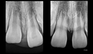 Blog - Dr Brice Riera - Endodontie - INtrusion severe