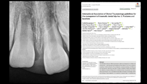 Blog - Dr Brice Riera - Intrusion severe