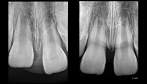 Blog - Dr Brice Riera - Patient de 8 ans Intrusion