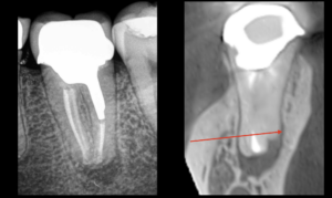 Dr Brice Riera - Endodontie - dent 37