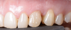 BLOG - Dr Brice Riera - Cas resorption