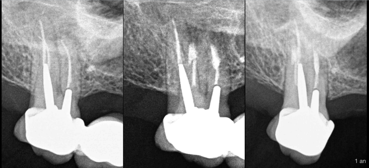 BLOG - Dr Brice Riera - Endodontie