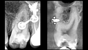 BLOG - Dr Brice Riera - Endodontie - pulpite aigue irreversible