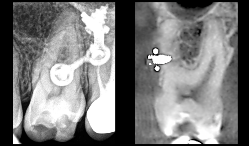 BLOG - Dr Brice Riera - Endodontie - pulpite aigue irreversible