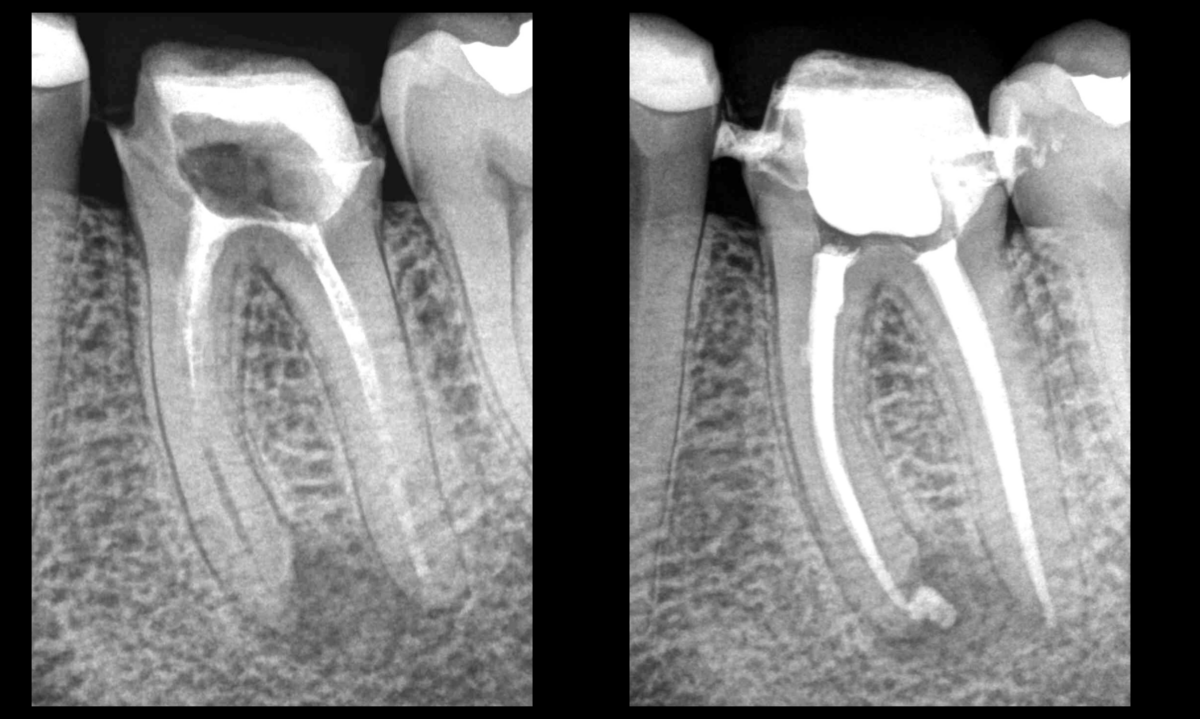 BLOG - Dr Brice Riera - Endodontiste - Diagnostic et solution endodontique