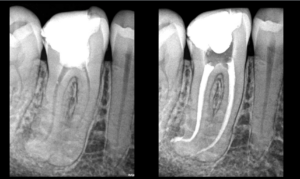 BLOG - Dr Brice Riera - Endodontiste - Les coudures en endodontie