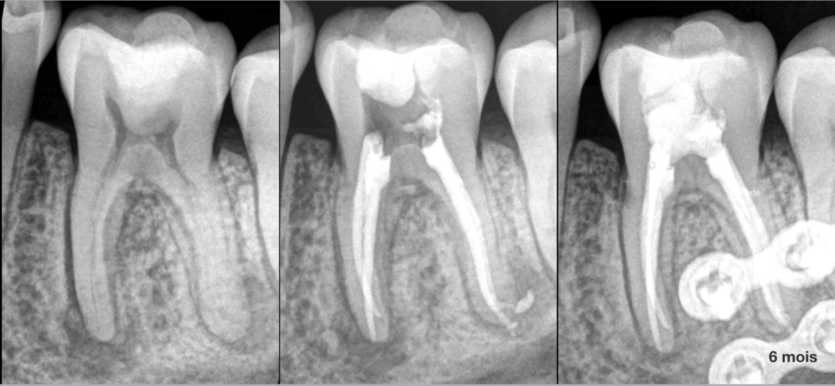 BLOG - Dr Brice Riera - Endodontiste Paris - osteosynthese
