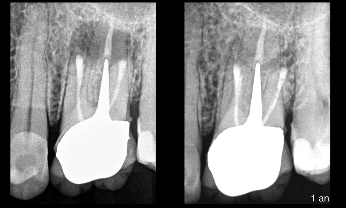 BLOG - Dr Brice Riera Endodontiste - longueur obturation et pronostic endodontique