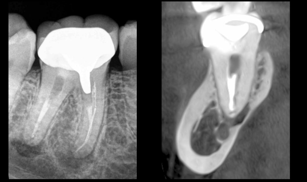 BLOG - Dr Brice Riera - Endodontiste - meilleure solution endodontique