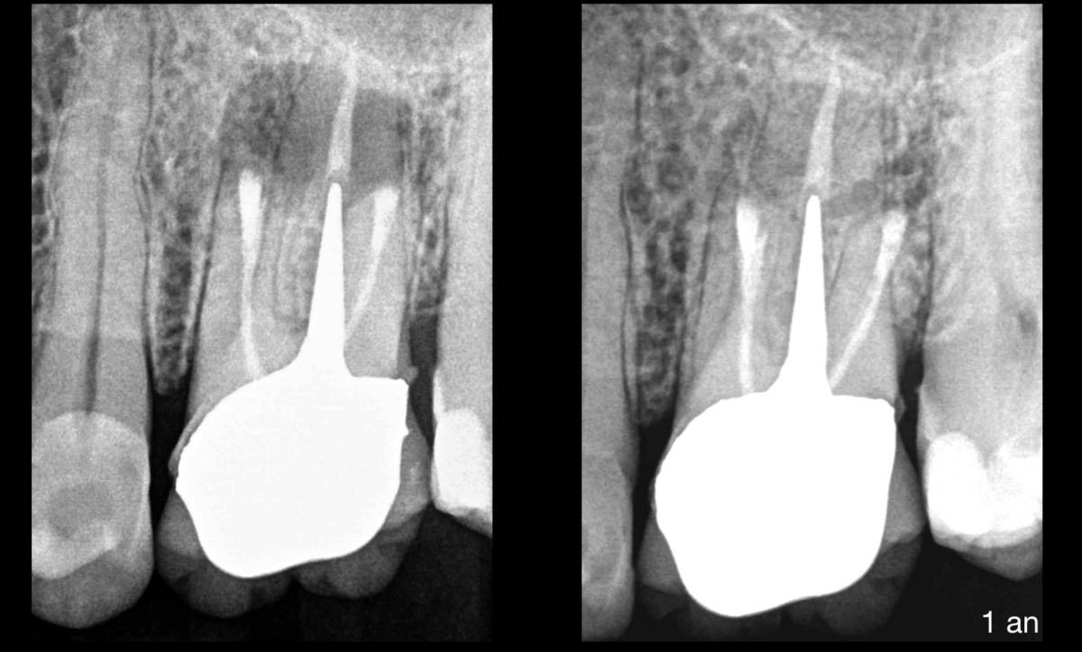 BLOG - Dr Brice Riera - Endodontiste - technique dhemostage et pronostic endodontique