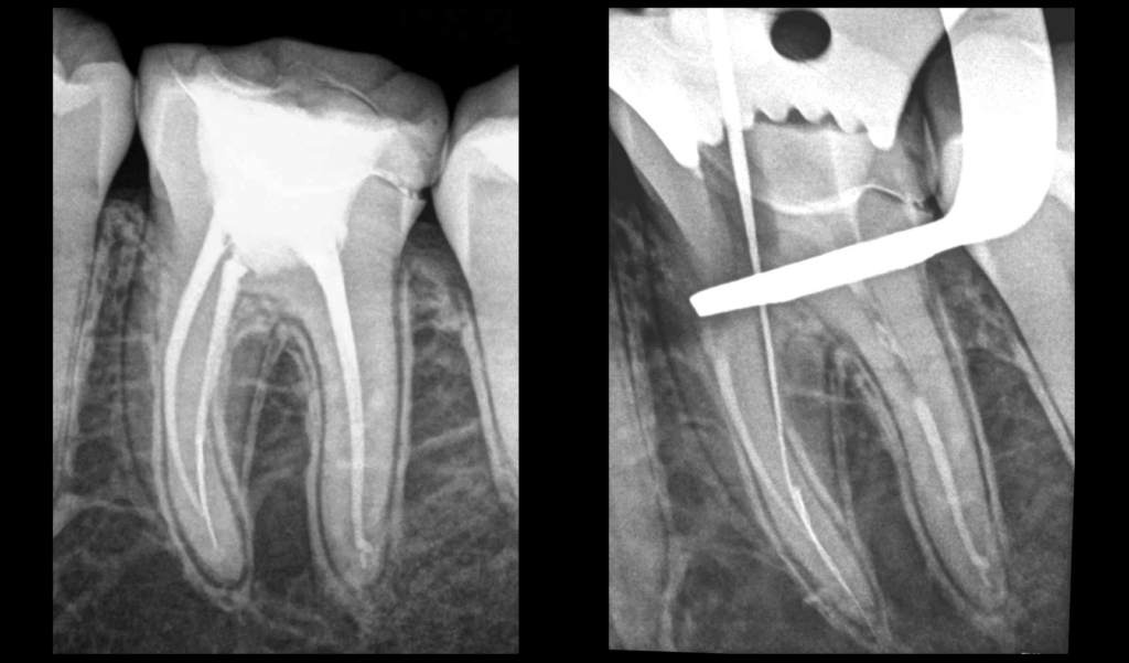 BLOG - Dr Brice Riera - Strategie instrument fracture endodontie