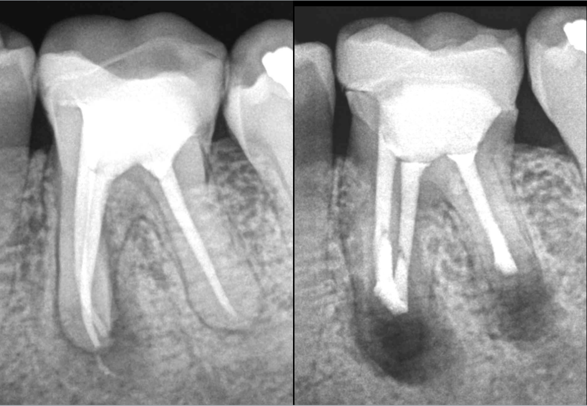 BLOG - DrBrice Riera - Endodontiste - Microchirurgie endodontique des racines M et D