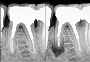 Blog - Dr Brice Riera - Endodontiste -