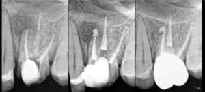Blog - Dr Brice Riera - Endodontiste - garantir l efficacite du traitement endodontique