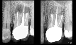 Blog - Dr Brice Riera - longueur de preparation optimale en chirurgie endodontique