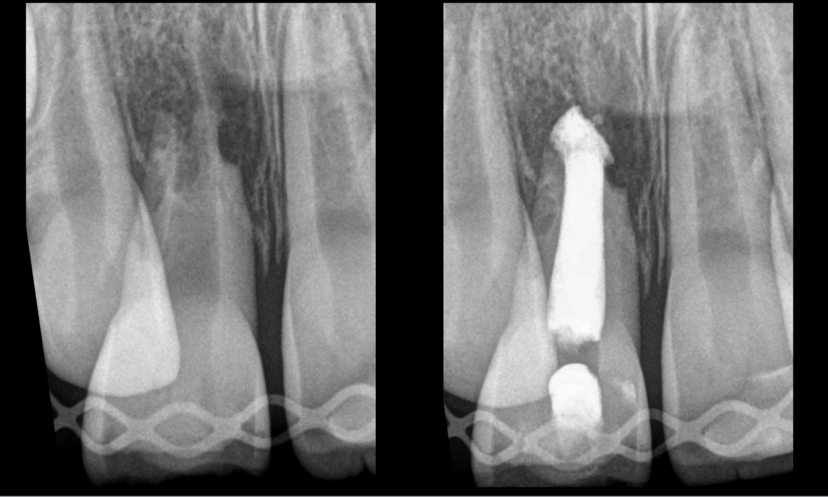 Blog - dr brice riera -endodontie - hydroxyde de calcium