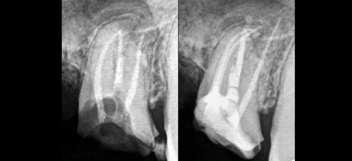 BLOG - Dr Brice Riera - Canaux courbes - Endodontie Paris
