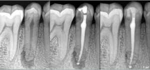 BLOG - Dr Brice Riera - Dens invaginatus - endodontie