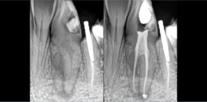 BLOG - Dr Brice Riera - Endodontie Chirurgie Dentaire Paris 17e - anatomie rare