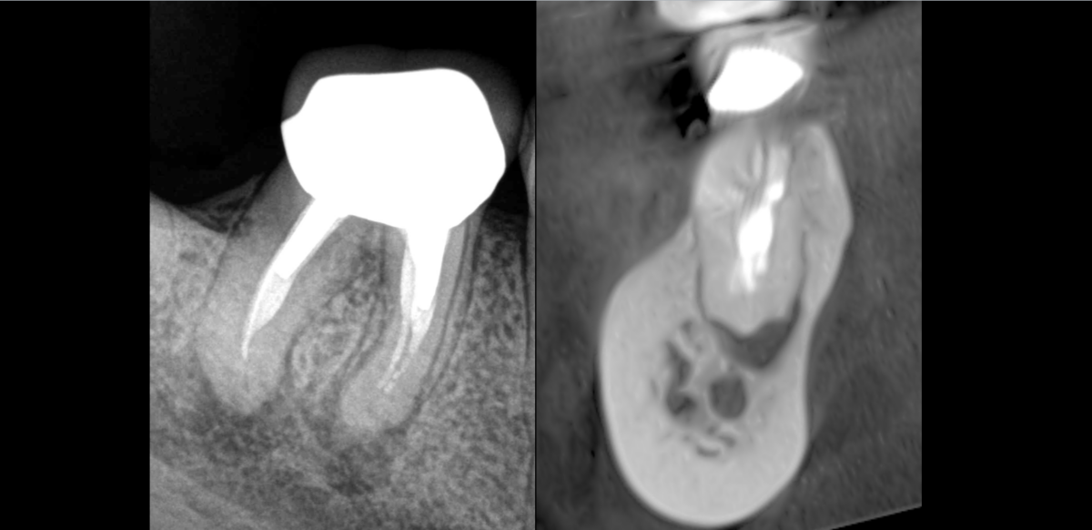 BLOG - Dr Brice Riera - Endodontie - cas patient