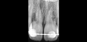 BLOG - Dr Brice Riera - Endodontie - hydroxyde de calcium