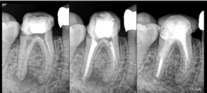 BLOG - Dr Brice Riera - Endodontie - le traitement parfait n existe pas