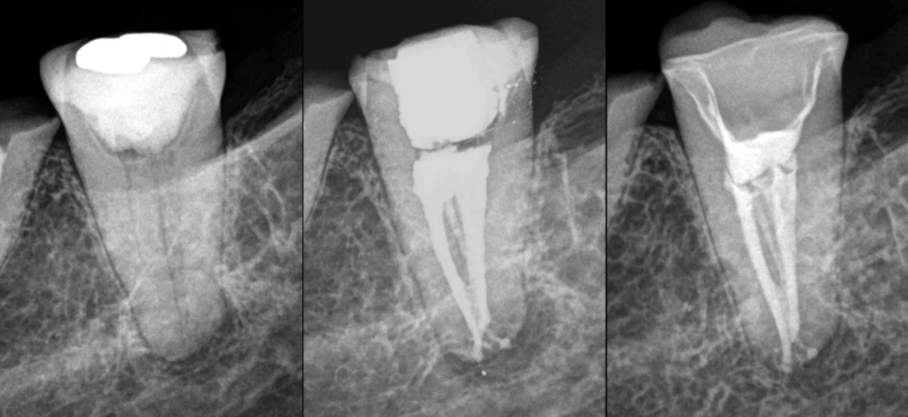 BLOG - Dr Brice Riera - Endodontie - paris 17e - cas patient
