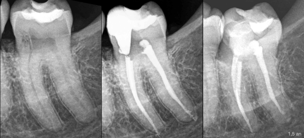 BLOG - Dr Brice Riera - Endodontie - wash out de biomateriaux - Paris